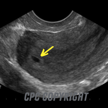 3 weeks after conception