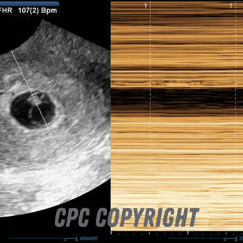 4 weeks after conception/6 weeks from your last period