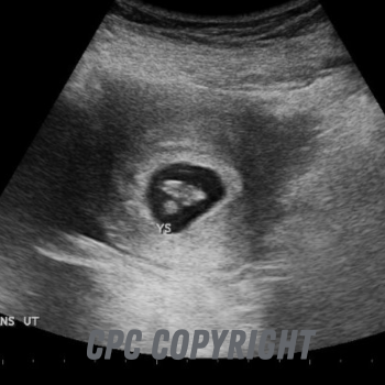 5 weeks after conception/ 7 weeks from your last period