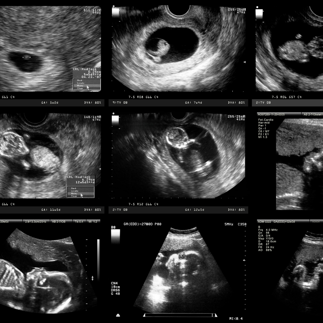 A collage of ultrasound of photos from a pregnancy
